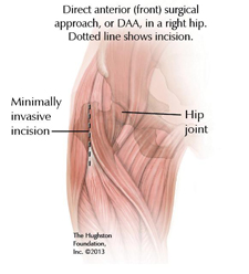 Direct Anterior Hip Incision