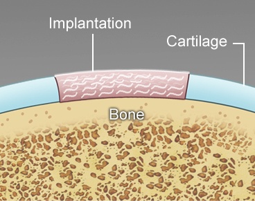 DeNovo® NT Natural Tissue Graft