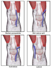 Knee Approaches