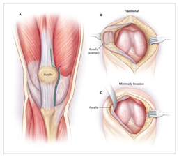 Muscle Sparing Knee Replacement
